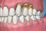 Abfration-Upper Maxillary Teeth